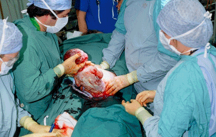 Image: Surgeons lifting a baby from its mother’s uterus during a Caesarean section delivery (Photo courtesy of Eddie Lawrence / SPL).